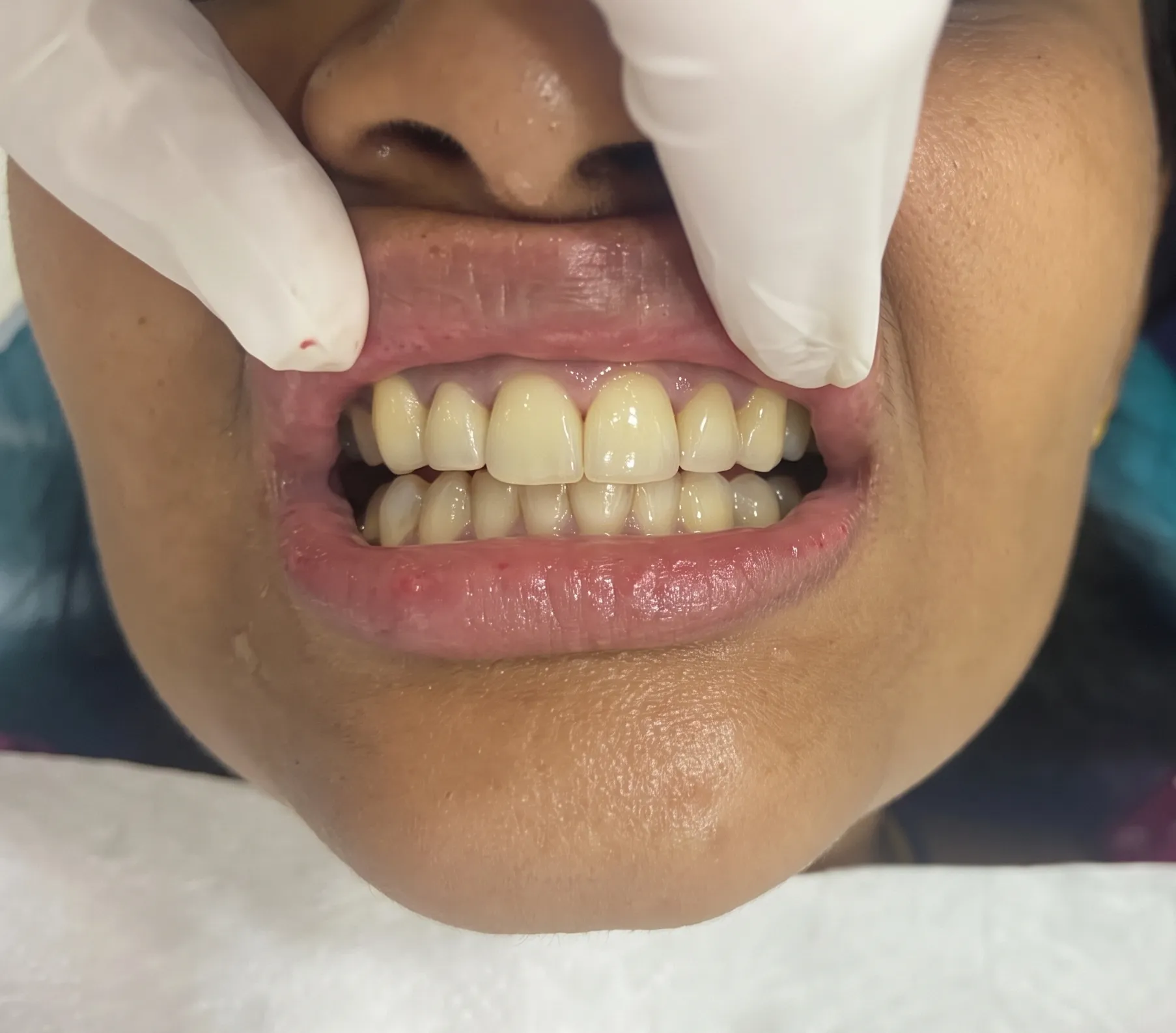 Aesthetic Dental Implant Restoration After Treatment