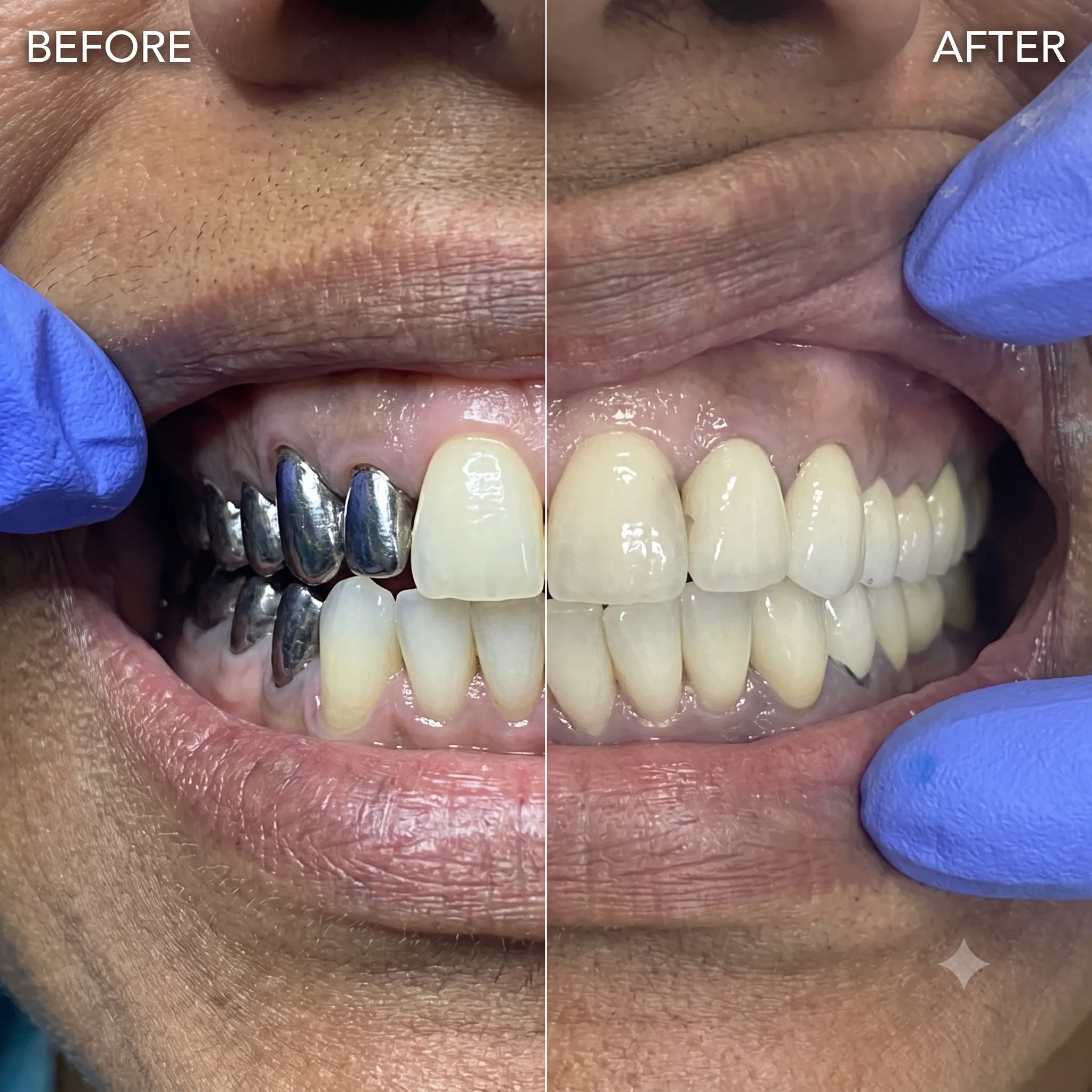 Complete Functional and Aesthetic Smile After Full Mouth Rehabilitation