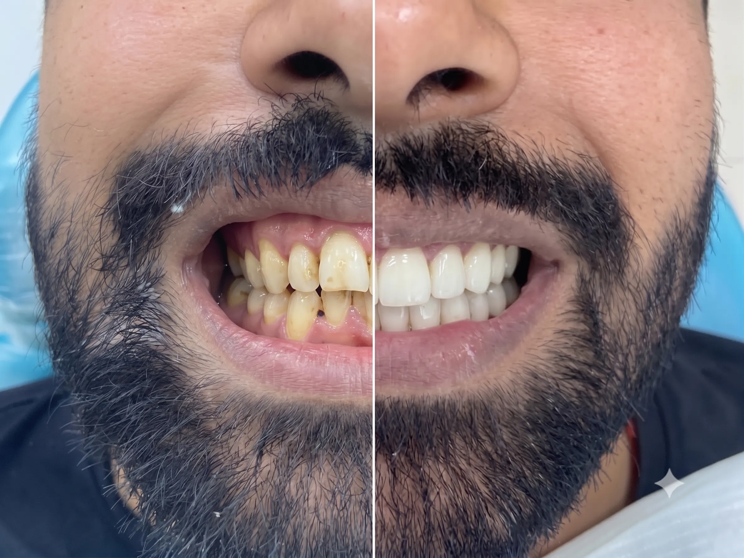 Bright White Teeth After Smile Makeover Whitening